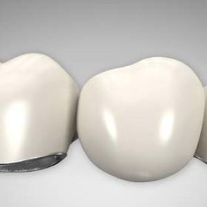 When a tooth is missing, a three-unit bridge can be a good choice for replacing it. In a three-unit bridge, an artificial tooth is connected on each end to crowns. The crowns are placed over the neighboring teeth to hold the bridge in place.