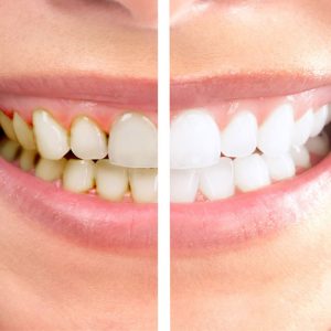 The Best Solution For Stained Teeth